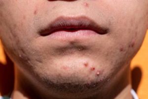 comment-reconnaître-l’acné-hormonale